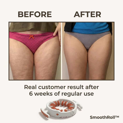SmoothRoll™ - Réducteur de cellulite à 360 degrés