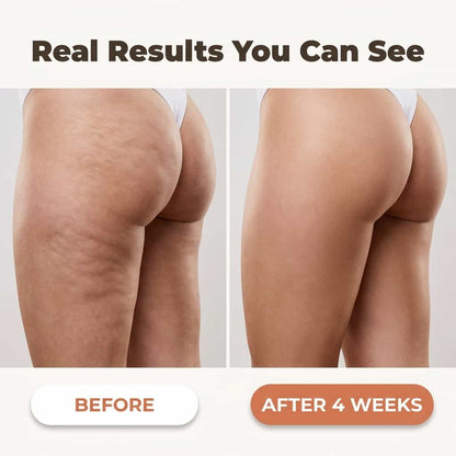 SmoothRoll™ - Réducteur de cellulite à 360 degrés